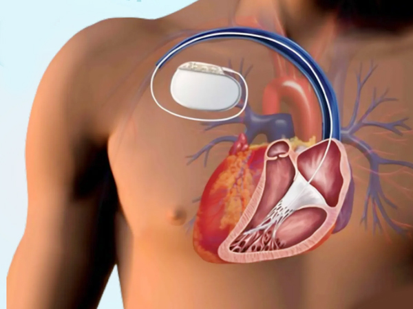 Automatic Implantable Cardioverter Defibrillator (AICD)