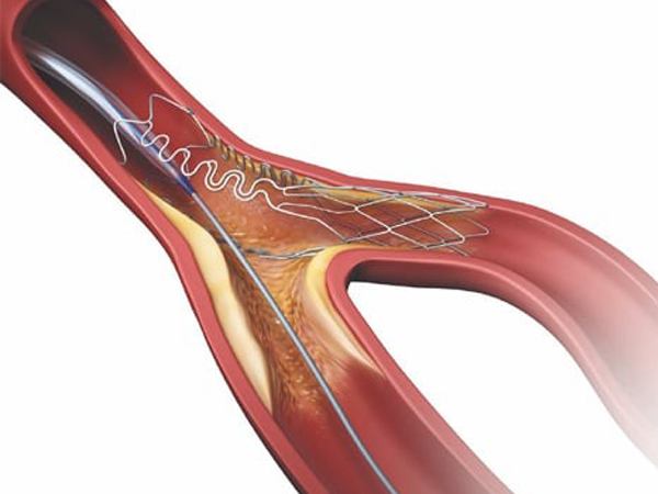 Bifurcation Angioplasty