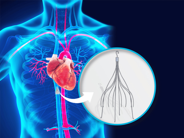 IVC Filter Placement