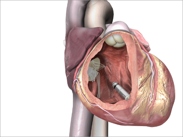 Leadless Pacemaker