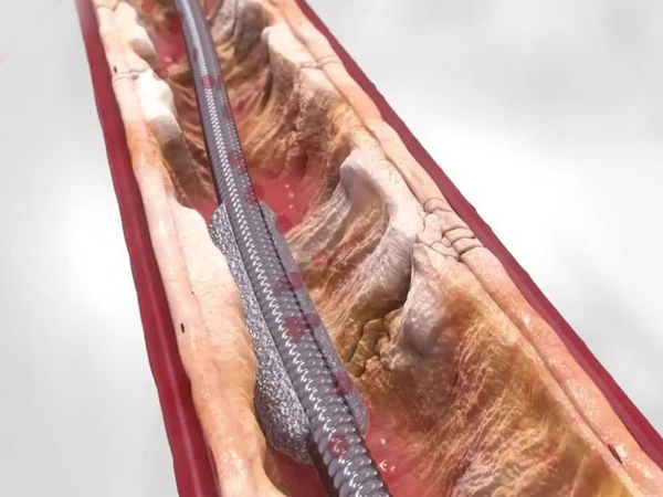 Orbital Atherectomy (OA)